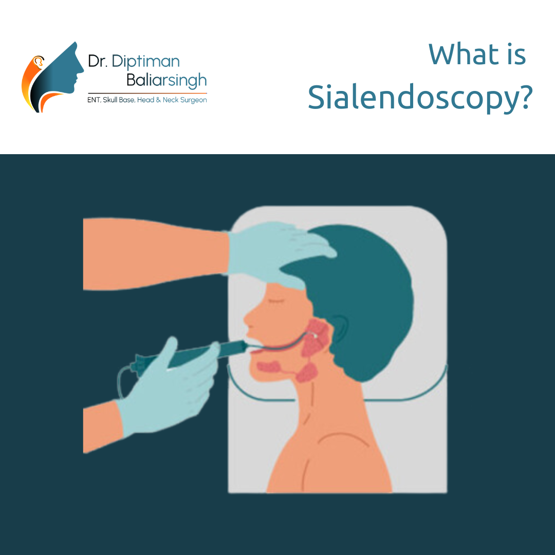 What is Sialendoscopy?