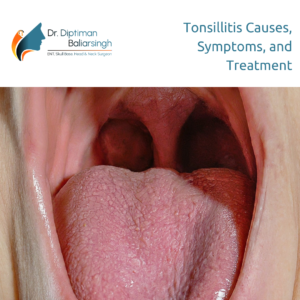 Tonsillitis Causes, Symptoms, and Treatment