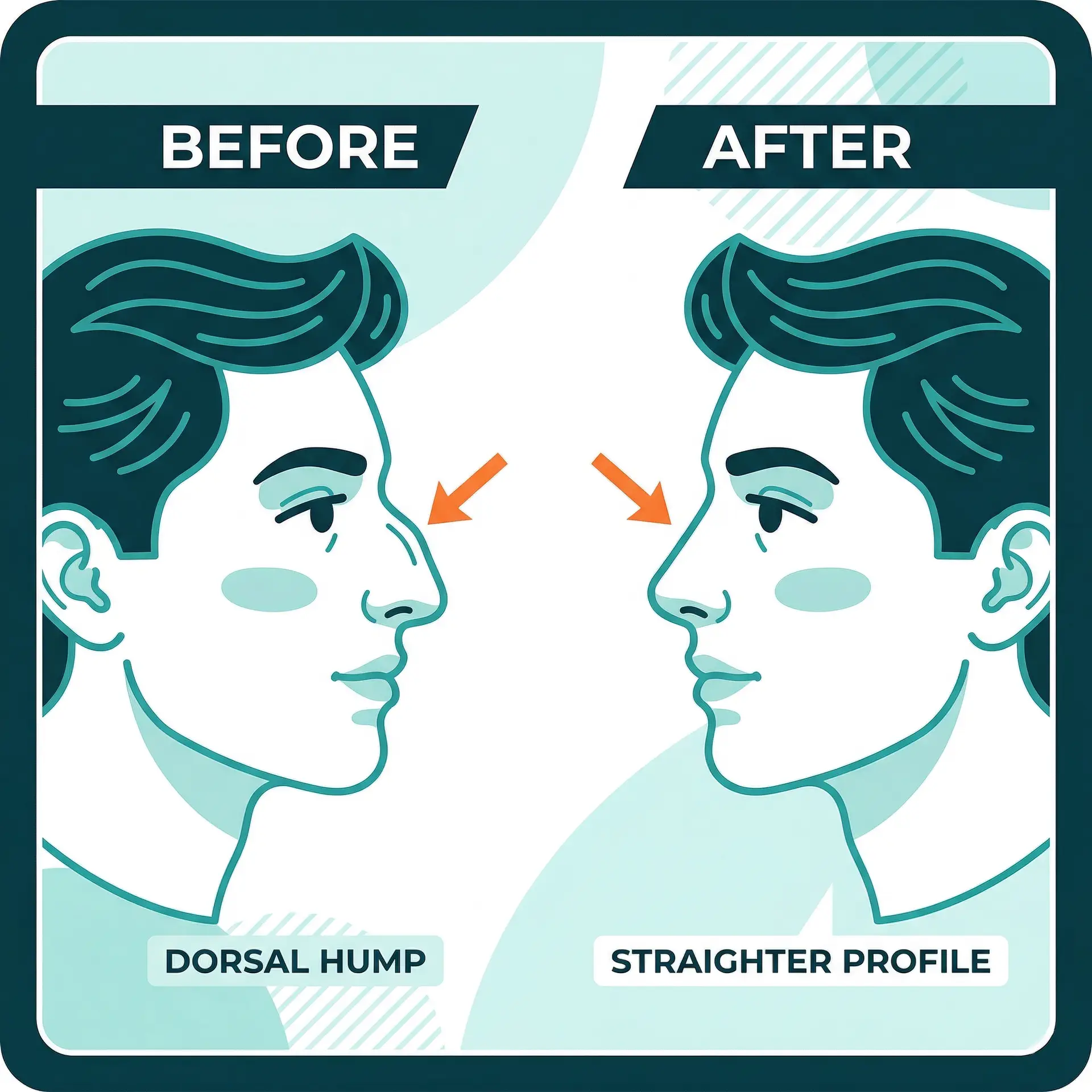 rhinoplasty surgery nose reshaping surgery