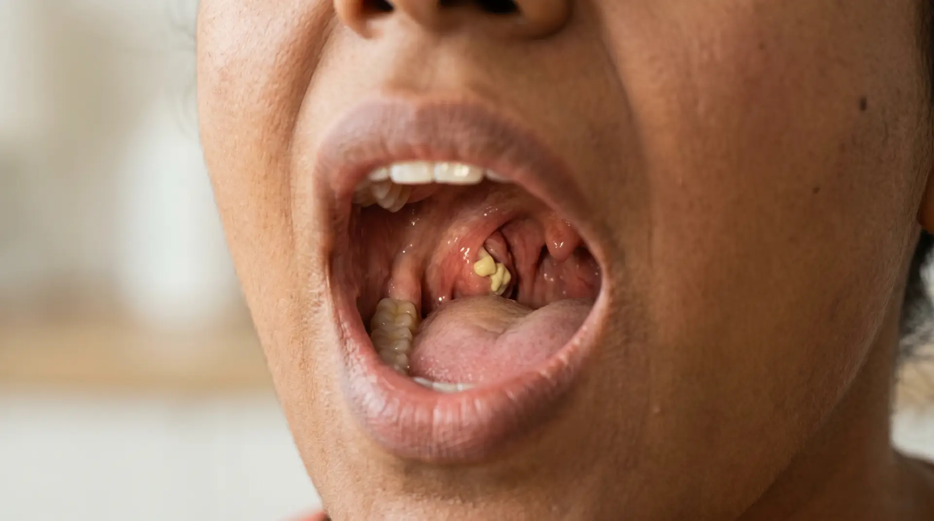 Close-up of an open mouth showing yellow dental tartar buildup on the back teeth and visible gums.