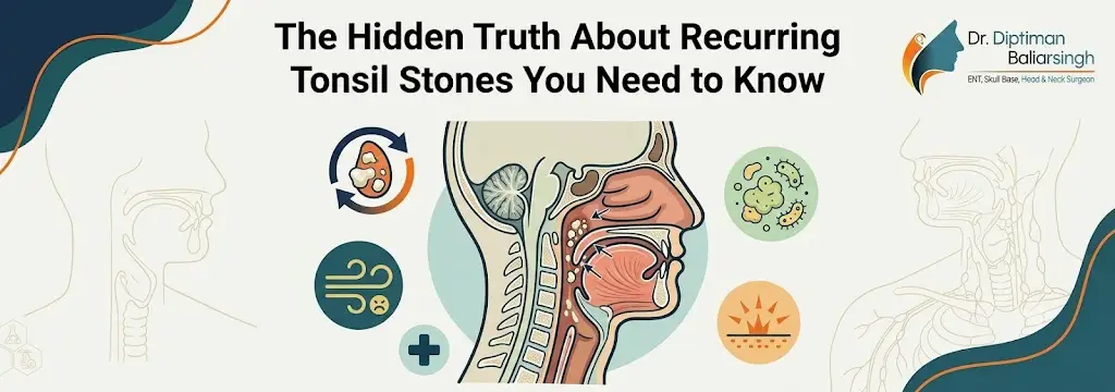 Educational banner about recurring tonsil stones with a cross‑section of the throat and related medical icons in the background.
